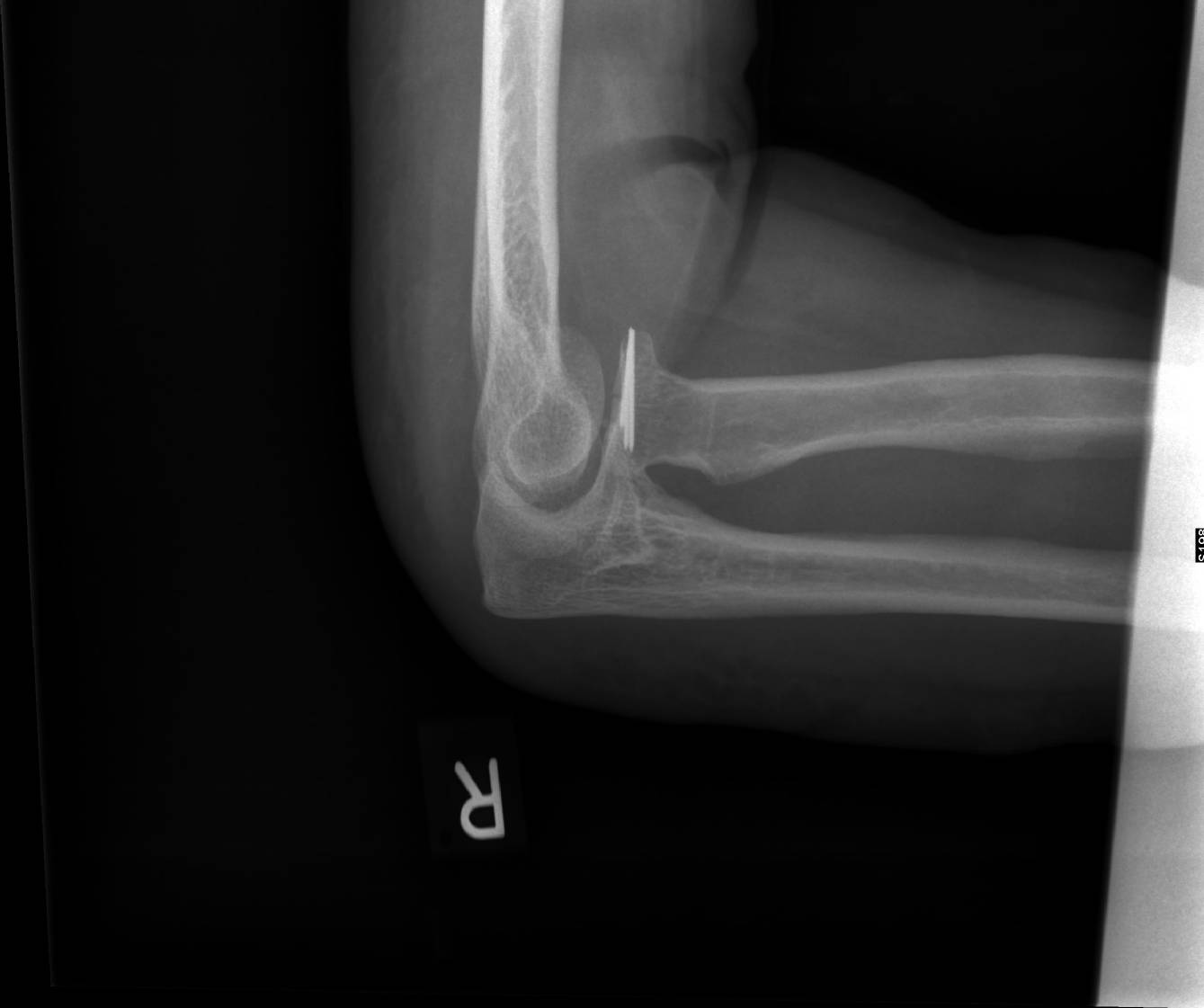 Heidemann - Hand- und Ellenbogenchirurgie in Hürth - Knochenbruchbehandlung